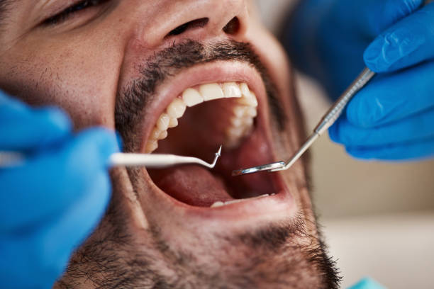 Best Emergency Wisdom Teeth Removal in Palm Springs North, FL